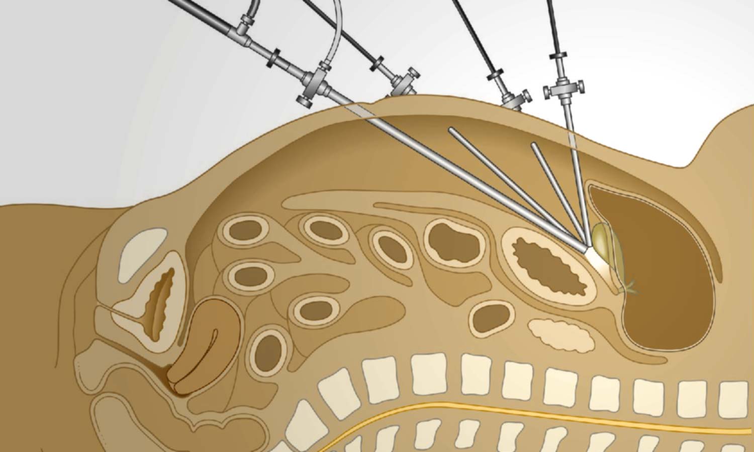 Λαπαροσκοπική χολοκυστεκτομή