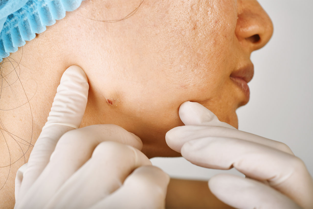 Σμηγματογόνος Κύστη