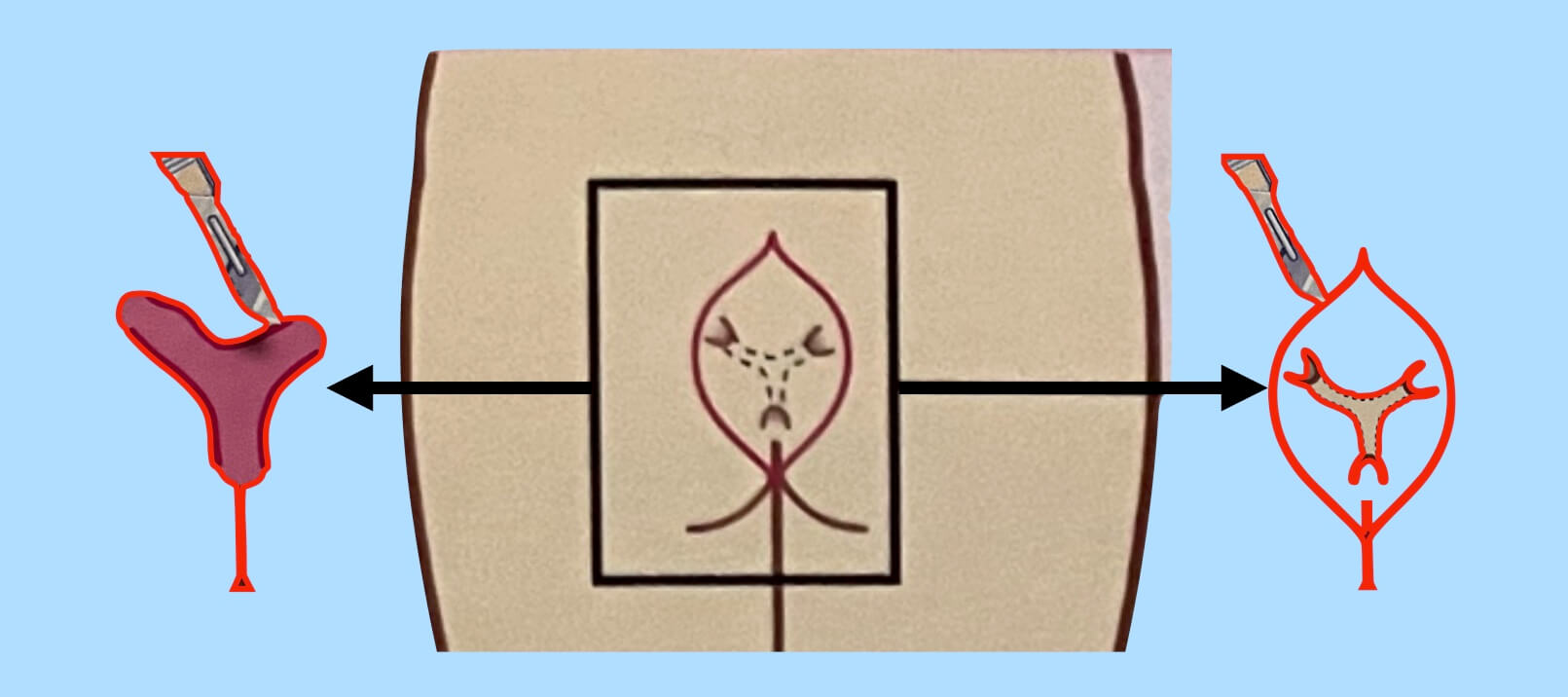 αφαίρεση κύστης κόκκυγος