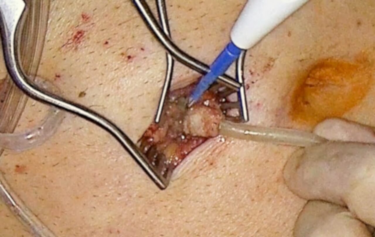 αφαίρεση port-a-cath