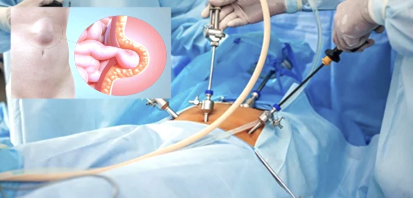 Λαπαροσκοπική αποκατάσταση κήλης