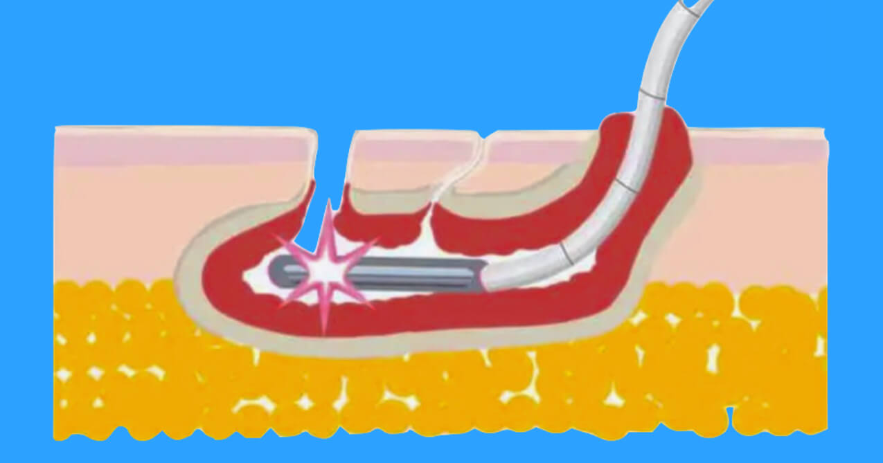 Laser Κύστης Κόκκυγος