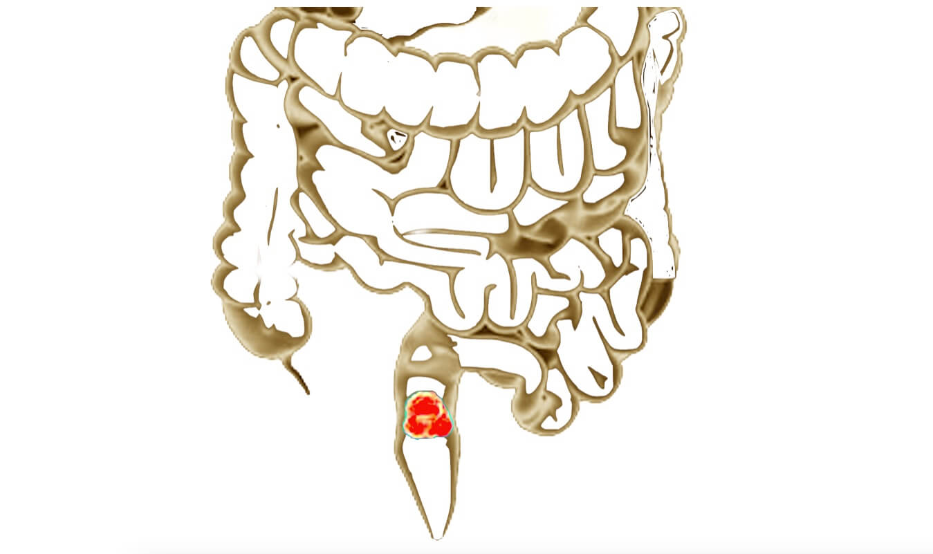 Καρκίνος Ορθού