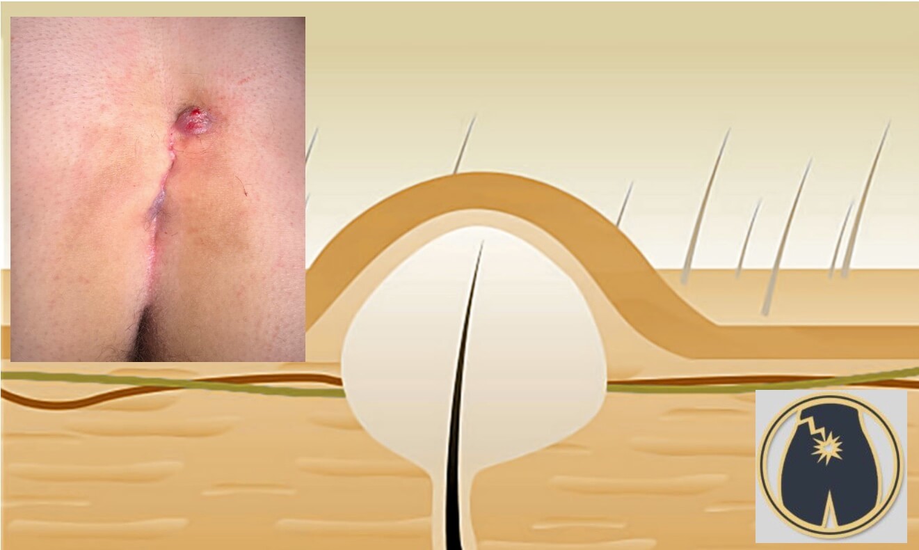 κύστη κόκκυγα