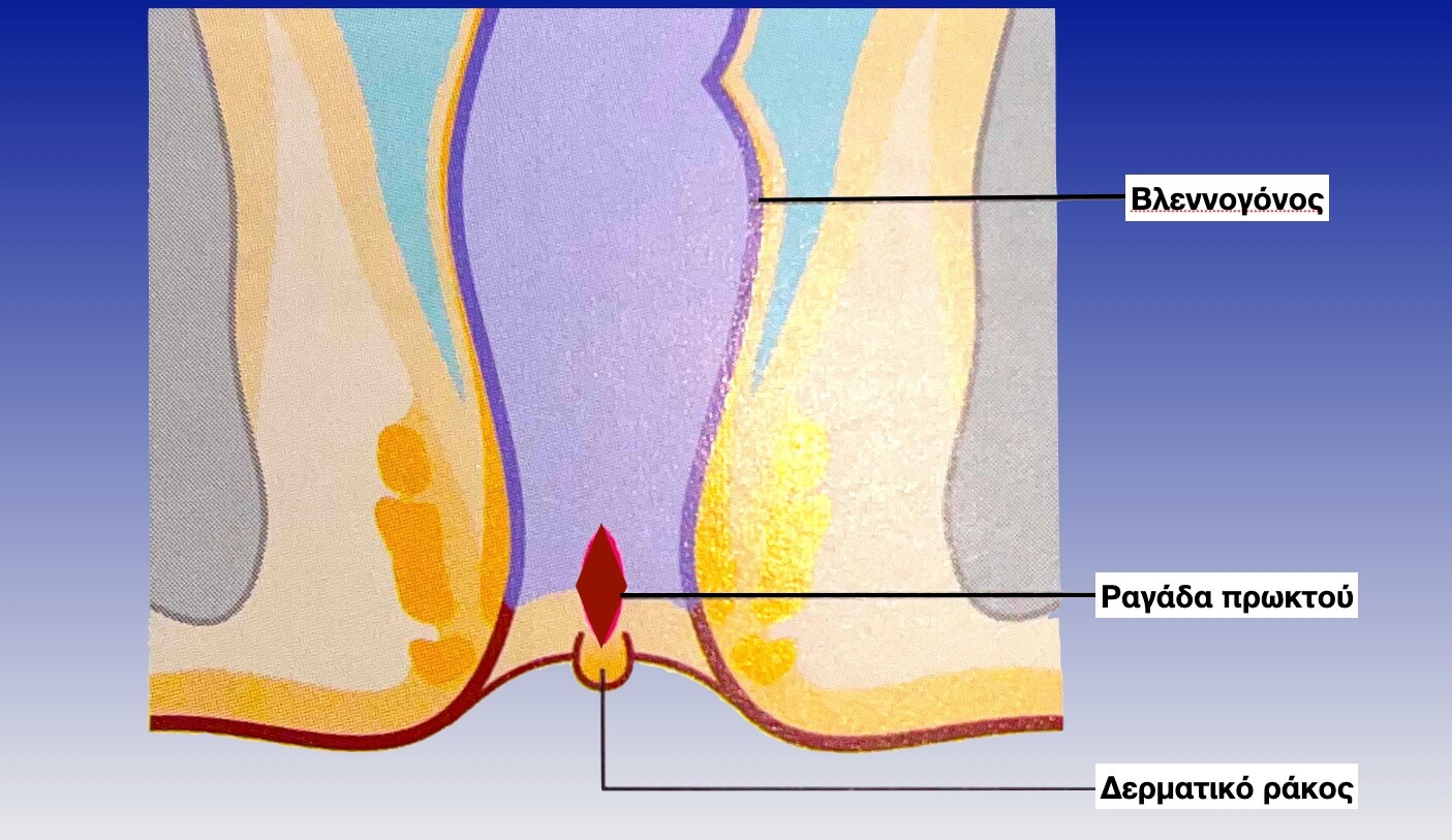 Ραγάδα πρωκτού