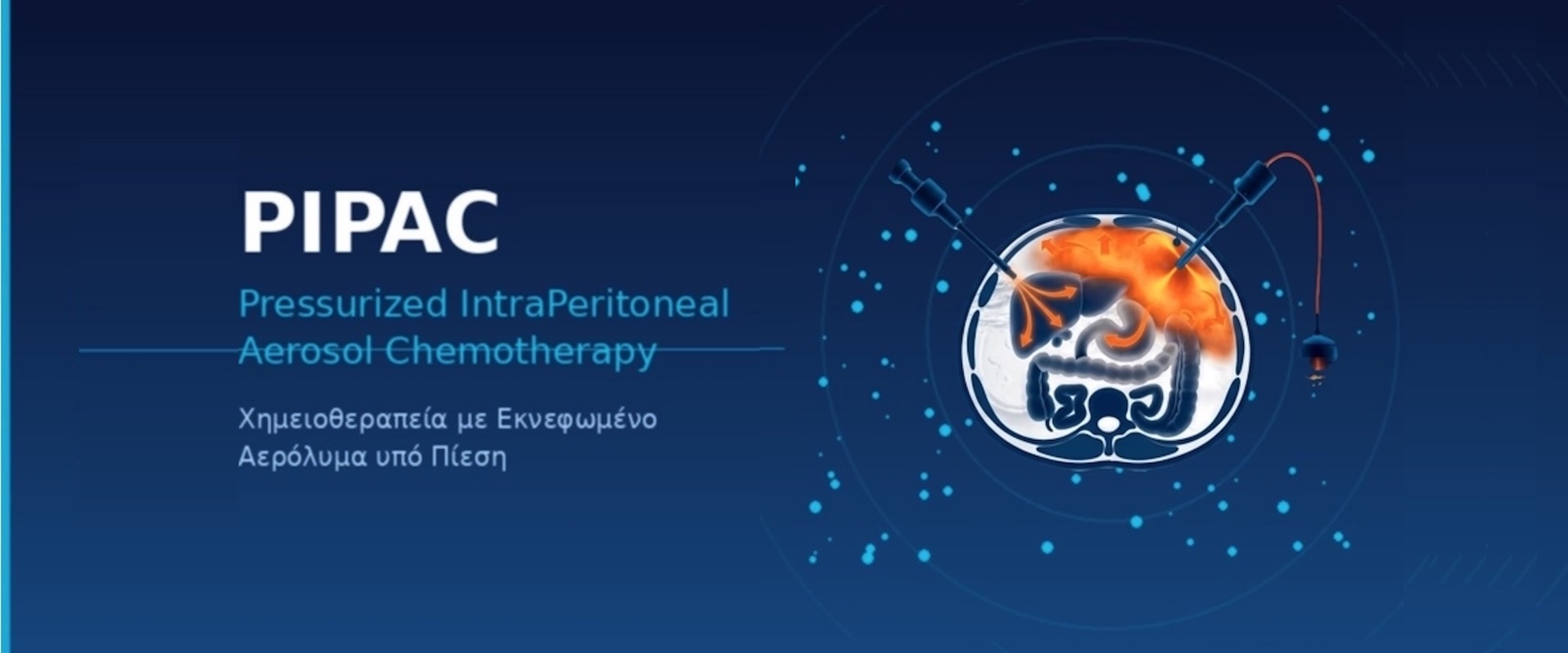 PIPAC σε καρκίνο παχέος εντέρου - λαπαροσκοπική χορήγηση εκνεφωμένου χημειοθεραπευτικού στην περιτοναϊκή κοιλότητα